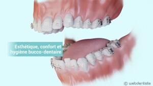Traitement orthodontique - Appareil autoligaturant en céramique